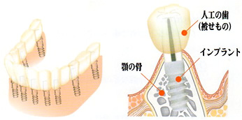 入れ歯