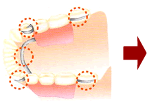 部分入れ歯